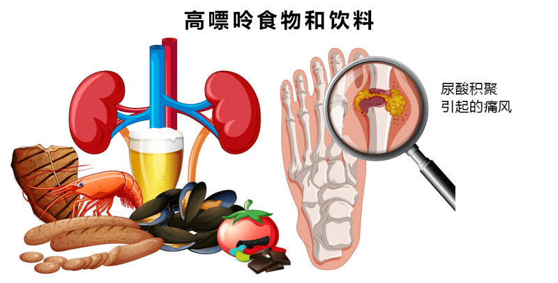 盘锦痛风患者指南:如何科学应对与治疗