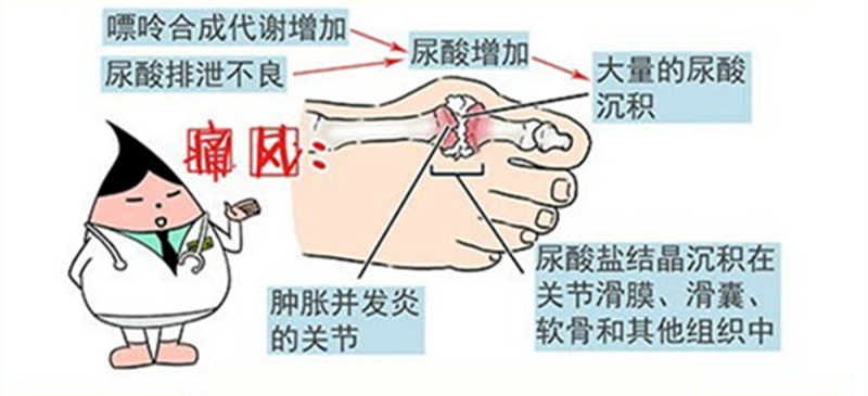 盘锦痛风治疗新进展:健康生活与科学疗法齐头并进