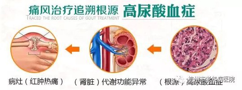 痛风治疗